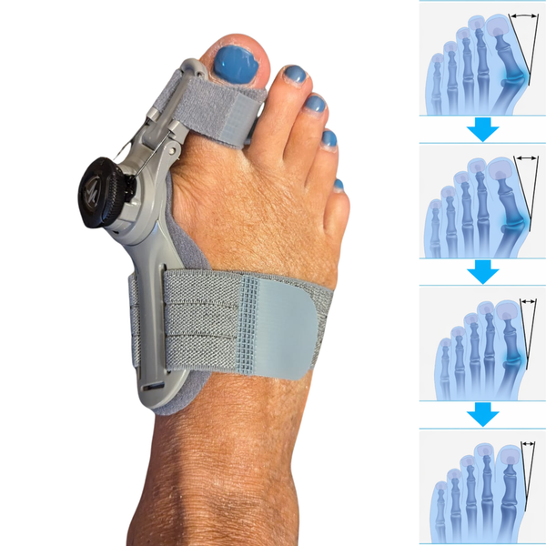 Comfort Fit Toe Aligners